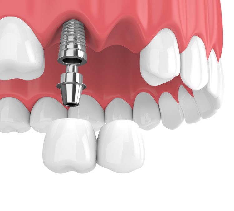 مزایا و معایب ایمپلنت دندان چیست ؟(پیشگیری از خطرات و عوارض ایمپلنت)