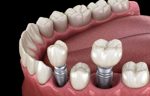 عوارض ایمپلنت دندان چیست ؟