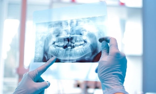 زمان مراجعه به بهترین متخصص ایمپلنت دندان در کرج