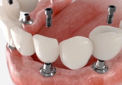 ایمپلنت دندان (کاشت دندان مصنوعی)چیست ؟مراحل جراحی ایمپلنت