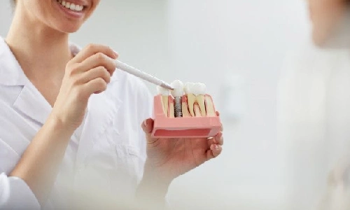 نکات مراقبت بعد از ایمپلنت دندان (رژیم غذایی بعد از کاشت دندان)