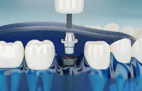 ایمپلنت های دندانی معمولا چه مدت دوام می آورند؟
