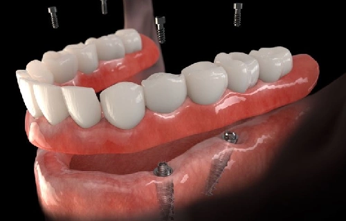 دندان مصنوعی ثابت چیست ؟