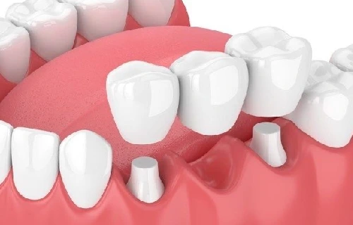 بریج دندان چیست ؟