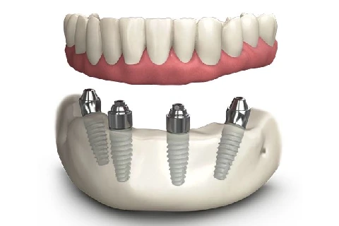 مقایسه اوردنچر و دندان مصنوعی: