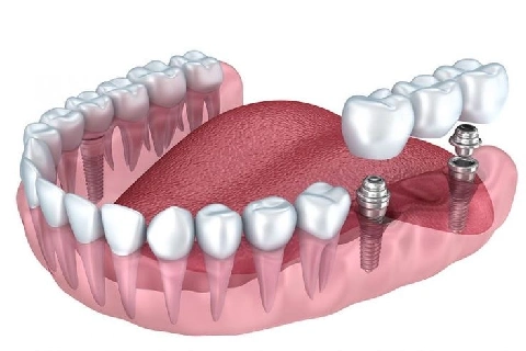 انواع بریج دندان کدام است ؟