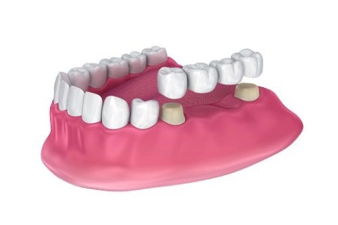 بریج دندان چیست ؟(معایب و مزایای پل دندان)