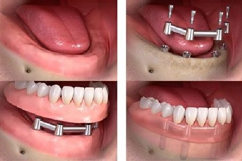 دندان مصنوعی ثابت چیست ؟