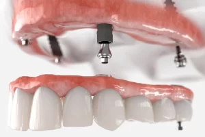 دندان مصنوعی ثابت بر پایه ایمپلنت چیست ؟ (قیمت دندان مصنوعی ثابت بر پایه ایمپلنت)