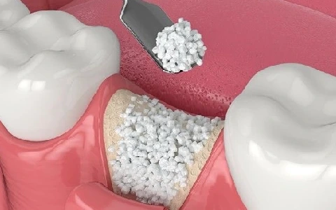 جراحی پیوند استخوان برای ایمپلنت دندان (دکتر نیکنام جهانفر)