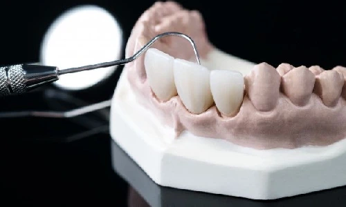بهترین نوع دندان مصنوعی برای افراد جوان کدام است
