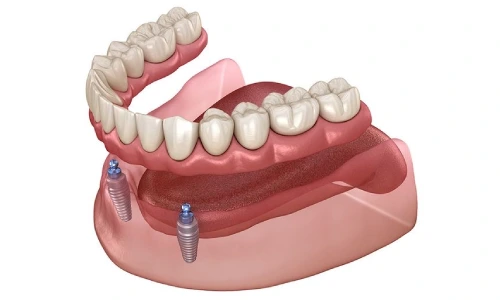 انتخاب دندان مصنوعی ثابت بهتر است یا متحرک ؟(مزایا و معایب و بررسی قیمت)