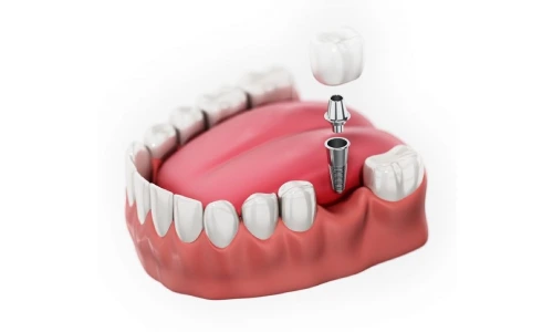 معایب و مزایای دندان مصنوعی ثابت یا ایمپلنت