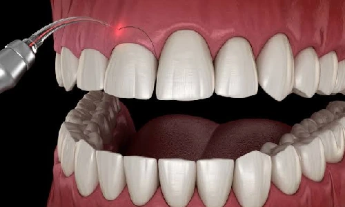 جراحی افزایش طول تاج دندان چیست؟(انواع جراحی افزایش طول تاج درمانی و زیبایی)