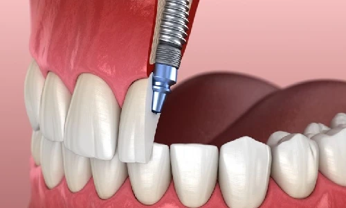 عوارض جراحی ایمپلنت چیست؟(ایمپلنت جایگزین دندان از دست رفته)